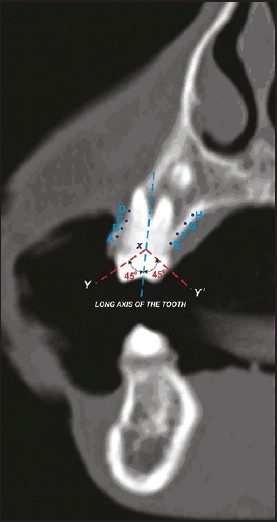 Figure 4: Coronal section view in computed tomography with buccal and palatal points marked at different levels for cortical bone thickness