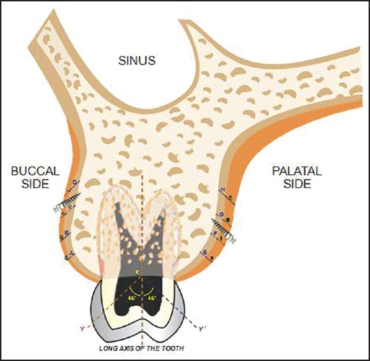 Figure 5: Schematic representation-coronal section view of appropriate mini-implant placement site located in buccal and palatal region