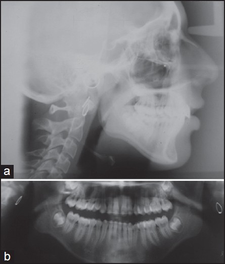 Figure 10: (a) Posttreatment cephalogram and (b) posttreatment orthopantomogram