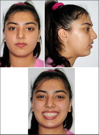 Figure 14: 1 year post-treatment extra-oral photographs