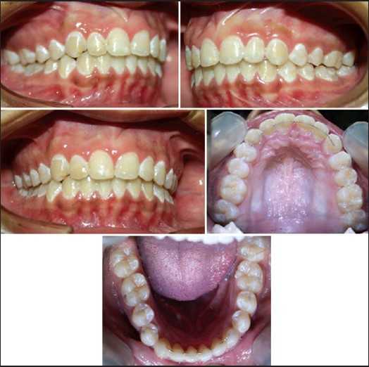Figure 15: 1 year post-treatment intra-oral photographs