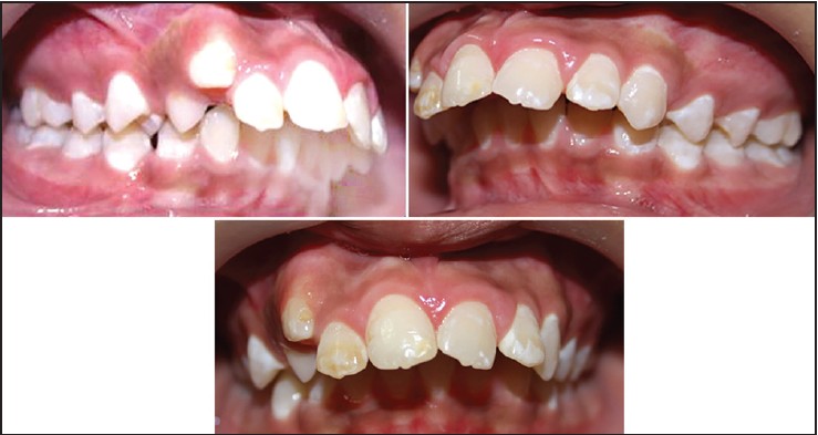 Figure 2: Pretreatment intra-oral photographs