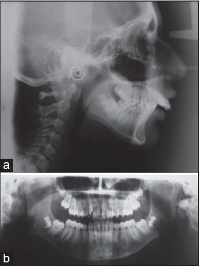 Figure 3: (a) Pretreatment cephalogram and (b) pretreatment orthopantomogram