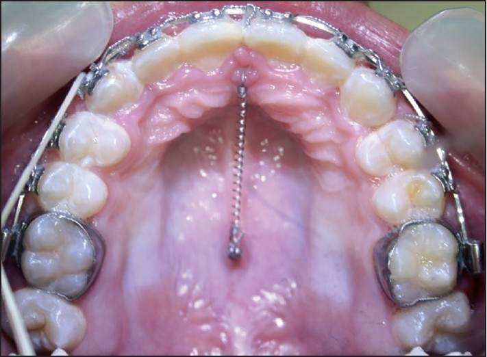 Figure 6: Placement of palatal micro-implant
