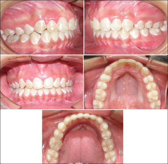 Figure 8: Posttreatment intra-oral photographs
