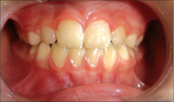 Figure 13: Intraoral frontal not tilted