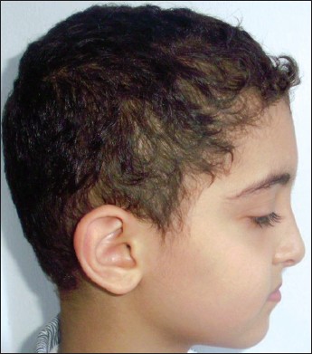 Figure 14: Lateral profile view-post treatment after two weeks