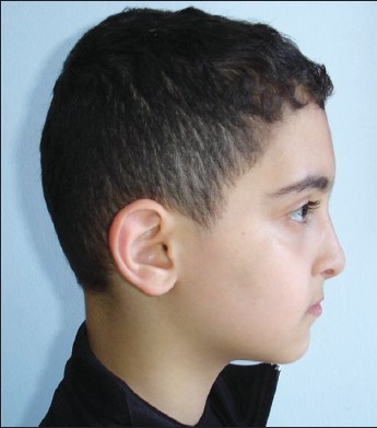 Figure 15: Lateral-profile view-post treatment after 2 years