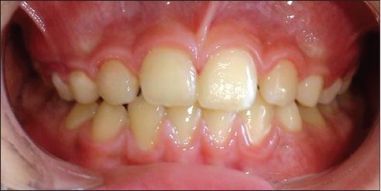 Figure 17: Frontal-intraoral view after 2 years