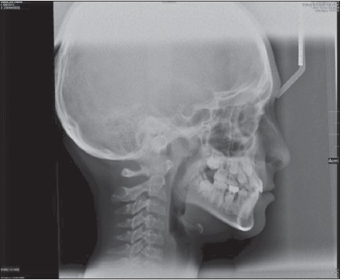 Figure 18: Post-treatment lateral cephalometric radiographs