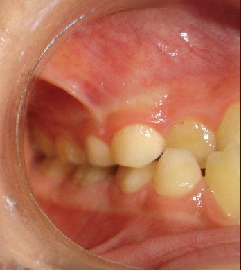 Figure 6: Right side-intraoral view