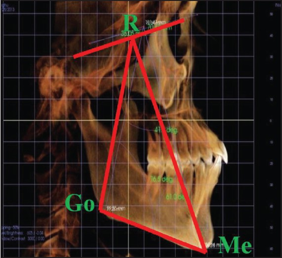 Figure 4: Lateral view mandible