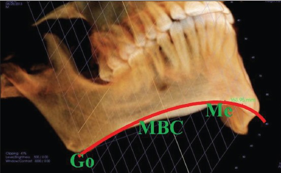 Figure 7: Mandibular basal curve length