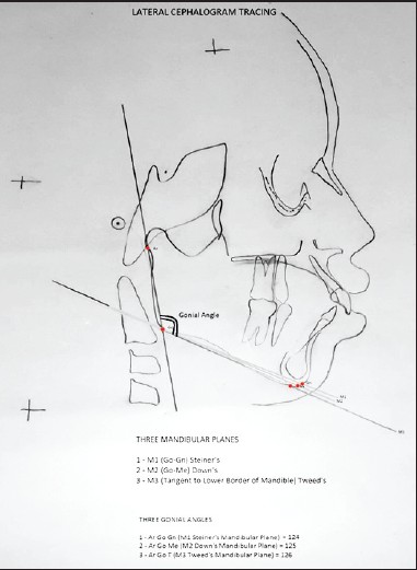 Figure 1: Cephalometric tracing on the lateral cephalogram showing the gonial angle determined using three different mandibular planes as described by Tweed's, Steiner's and Down's