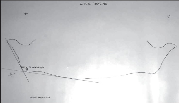 Figure 2: Cephalometric tracing on a panoramic radiograph showing the gonial angle determined from two tangents drawn from the inferior border of the mandible and the posterior borders of the condyle and ramus on both sides