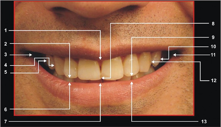 Figure 1: Photographic points: 1. The most inferior point on the inferior curvature of the upper lip (C Low), 2. Point on the incisal edge of the upper right lateral incisor, where the long axis of the tooth intersects the incisal edge (RL), 3. The innermost corner of the lip on the right side (Rch), 4. Point on the most lateral surface of the upper canine of the right side (RCus), 5. Point on the lateral surface of the upper premolar of the right side (R PM), 6. Point on the upper curvature of the lower lip, directly inferior to point RL (R Lab), 7. The midmost point on the upper curvature of the lower lip, directly inferior to point C (C lab), 8. The midmost and incisal-most point between the incisal edges of the upper central incisors (C), 9. Point on the incisal edge of the left
lateral incisor, where the long axis of the tooth intersects at the incisal edge (LL), 10. Point on the lateral surface of the upper premolar of the left side (L PM), 11. The inner most corner of the lip on the left side (LCh), 12. Point on the most lateral surface of the upper canine on the left side (LCus), 13. Point on the upper curvature of lower lip directly inferior to point LL (L Lab)