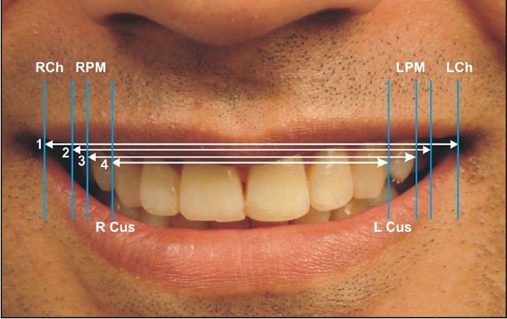 Figure 2: Linear measurements in transverse plane: 1. Smile width or intercommissure width-Distance between most medial points on the lips at the angle of the mouth (left to right cheilion, RCh to LCh). 2. Visible dentition width-Distance between the most lateral left and right buccal points on maxillary dentition. 3. Interpremolar distance- Distance between the most distal visible points on the fi rst premolar (in case of extraction second premolars) (RPM to LPM). 4. Maxillary intercanine width-Distance between the most distal visible points on the canines (R Cus to L Cus)