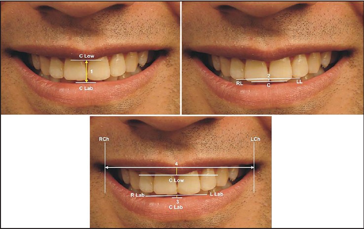 Figure 4: Linear measurements in the vertical plane: 1. Smile height- Distance from the most inferior point on the upper lip between the maxillary central incisors to the most superior point on the lower lip, on a perpendicular vertical line from the upper point (C Low to C Lab). 2. Length of the perpendicular ofthe arc of the upper incisor- Perpendicular distance from the straight edge through points RL and LL to point C. 3. Length of the perpendicular for the arc of the lower lip-Perpendicular distance from the straight edge through points RLab and LLab to point C Lab. 4. Upper lip curvature (Positive or Negative)-A straight edge was aligned through points RCh and LCh, and point C Low was observed to determine whether or not the point was inferior or superior to the line established determined as positive if the corners of the smile were superior to the center of the upper lip, andnegative if the corners of smiles were below the corner of upper lip
