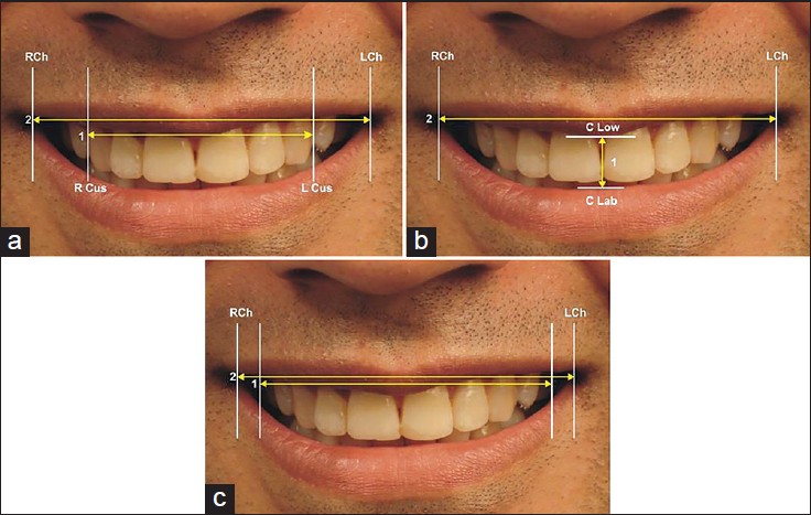 Figure 5: Various ratios: (a) Ratio 1 (Buccal corridor) = Maxillary intercanine width (1)/Smile width (2); (b) Ratio 2 = Maxillary smile height (1)/Maxillary smile width (2); (c) Ratio 3 = Visible dentition width (1)/Smile width (2)