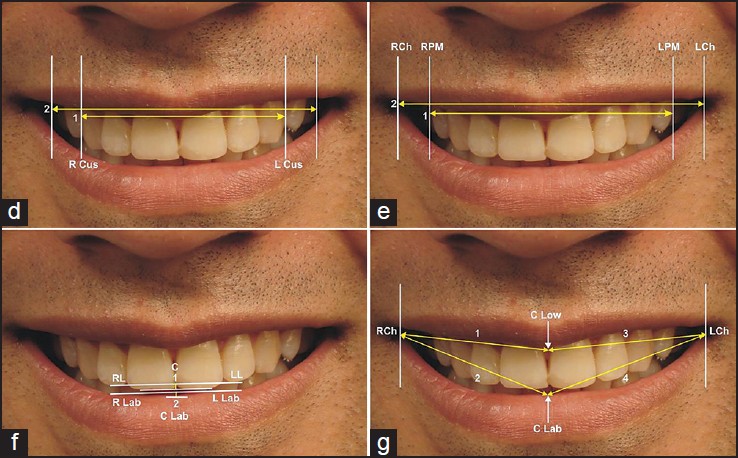 Figure 6: Various ratios: (d) Ratio 4 = Maxillary intercanine width (1)/ Visible dentition width (2); E. Ratio 5 = Interpremolar distance (1)/ Smile width (2); (f) Ratio 6 (Smile line ratio) = Length of perpendicular for the arc of upper incisors (1)/Length of perpendicular for the arc of lower lip (2); (g) Ratio 7 (Smile symmetry ratio) = Distance from RCh to C Low + Distance from RCh to C Lab (1 + 2)/Distance from LCh to C Low + Distance from LCh to C Lab (3 + 4)