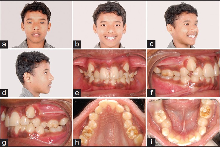 Figure 1: (a-1) Pretreatment extra oral and intra oral photographs