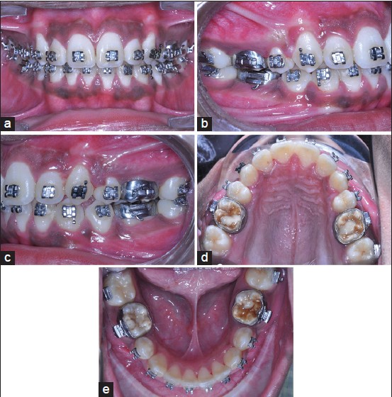 Figure 3: (a-e) Mid-treatment intra oral photographs
