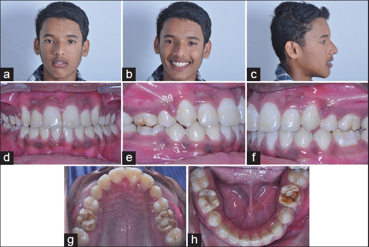 Figure 4: (a-h) Posttreatment extra oral and intra oral photographs