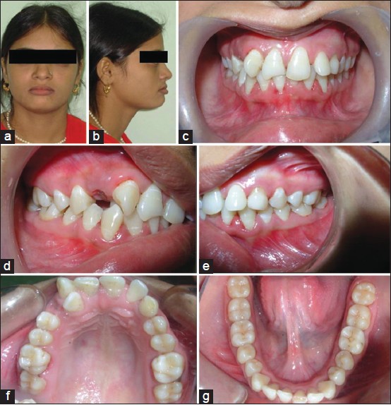 Figure 1: Pretreatment Photographs. Extraoral: Frontal view (a) and profile view (b). Intraoral: frontal view (c), right lateral view (d), left lateral view (e), upper occlusal view (F) and lower occlusal view (g)