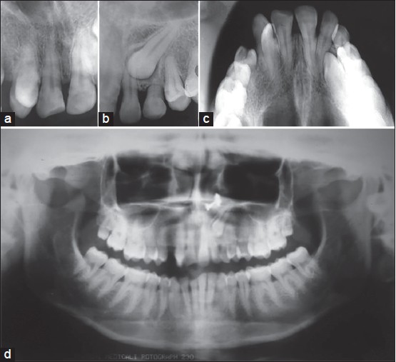 Figure 2: Pretreatment radiographs. (a) Intra oral periapical (IOPA) X-ray showed complete transposition of maxillary right canine and lateral incisor. (b) IOPA X-ray showed impacted maxillary left canine and retained deciduous canine. (c and d) Occluasal and orthopantomogram radiographs showed complete transposition of maxillary right canine and lateral incisor and impacted maxillary left canine