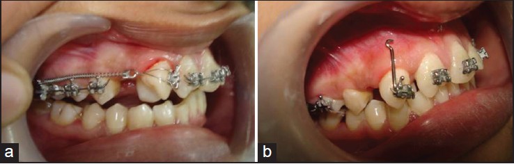 Figure 3: Intraoral photograph showed use close coil spring for mesioangular rotation correction and distal movement of maxillary right canine (a) and power arm on maxillary right canine bracket, which coincides to the center of resistance and helps bodily movement of canine (b)