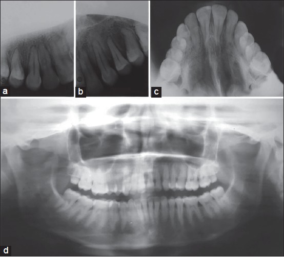Figure 7: Posttreatment radiographs. (a) Intra oral periapical (IOPA) X-ray showed well aligned transposed maxillary right canine and lateral incisor. (b) IOPA X-ray showed well aligned impacted maxillary left canine. (c and d) Occlusal and orthopantomogram radiographs showed well-aligned transposed maxillary right canine and lateral incisor and impacted maxillary left canine
