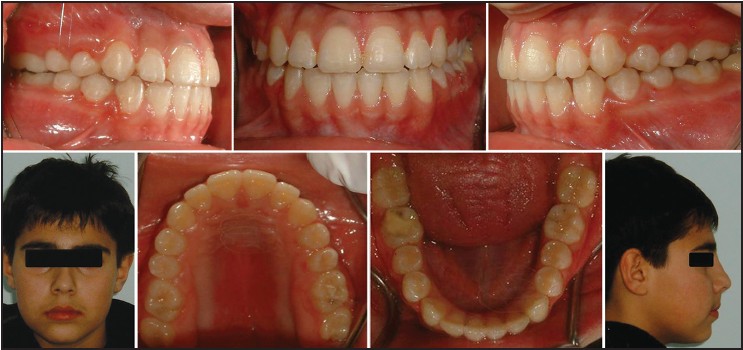 Figure 8: Posttreatment intraoral and extraoral photographs of Case I