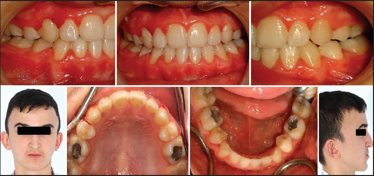 Figure 9: Posttreatment intraoral and extraoral photographs of Case II