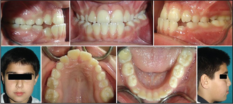 Figure 1: Preprotraction intraoral and extraoral photographs of Case I