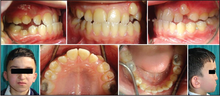 Figure 2: Preprotraction intraoral and extraoral photographs of Case II