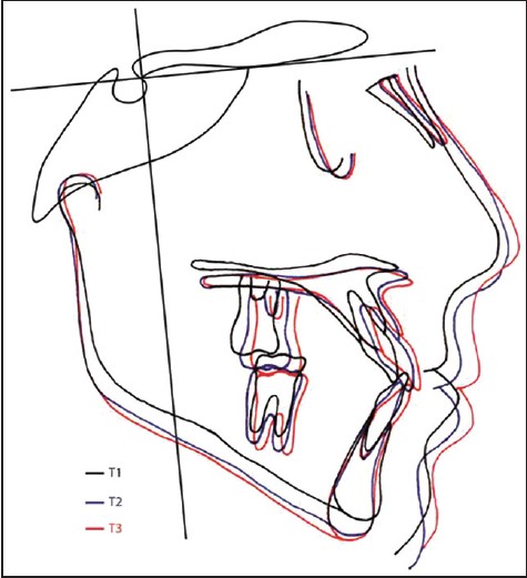 Figure 4: Preprotraction, postprotraction and posttreatment cephalometric superimposed tracings of Case I