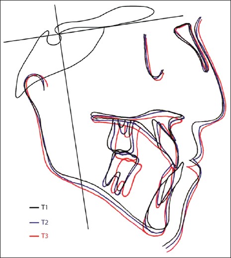 Figure 5: Preprotraction, postprotraction and posttreatment cephalometric superimposed tracings of Case II