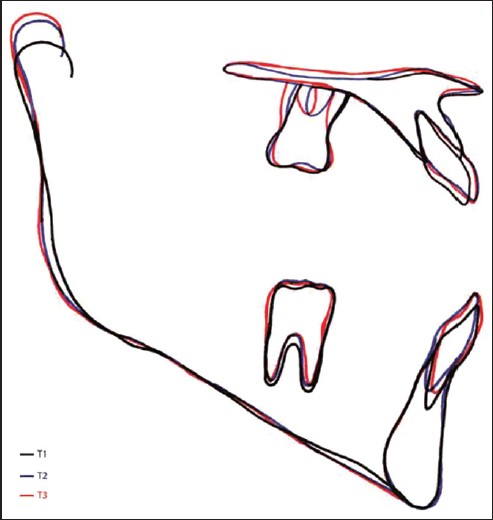Figure 6: Local preprotraction, postprotraction and posttreatment cephalometric superimposed tracings of Case I