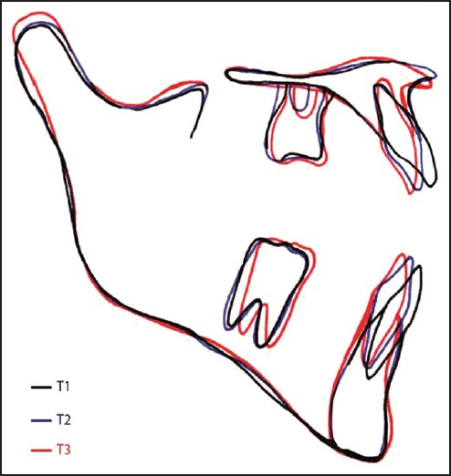 Figure 7: Local preprotraction, postprotraction and posttreatment cephalometric superimposed tracings of Case II