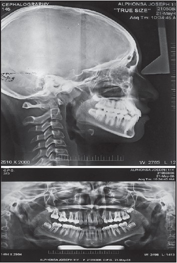 Figure 3: Pretreatment orthopantomogram and lateral cephalogram