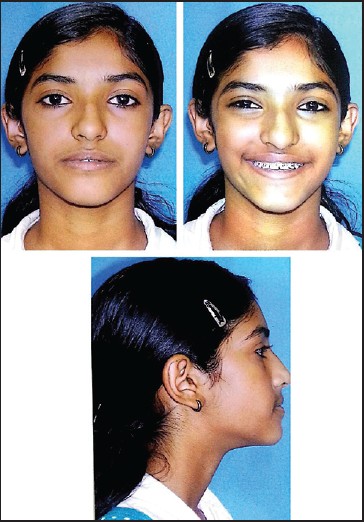 Figure 4: Post Face Mask therapy extra-oral photographs