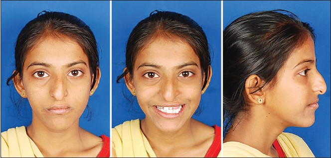 Figure 5: Extraoral photographs after rapid maxillary expansion and facemask therapy