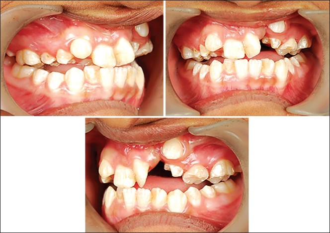 Figure 6: Intraoral photographs after rapid maxillary expansion and facemask therapy