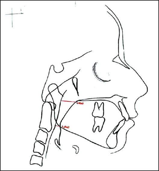 Figure 1: Upper and lower pharyngeal airways width