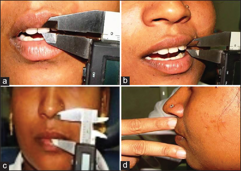 Figure 1: (a) Distance between maxillary lip at rest to left maxillary central incisor measured. (b) Distance between maxillary lip at rest and left maxillary canine measured. (c) Maxillary lip length measured.
(d) Assessment of anteroposterior skeletal relation