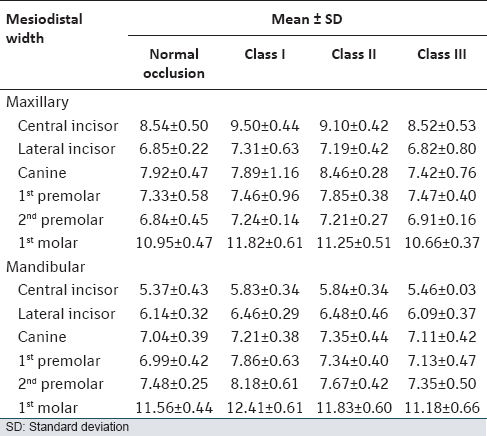 Table 1: Mean and SD of mesiodistal width of each tooth in normal occlusion and malocclusion groups