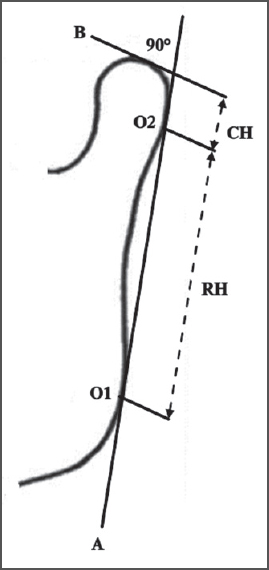 Figure 1: Measuring vertical mandibular asymmetry by Habets <i>et al</i>. method