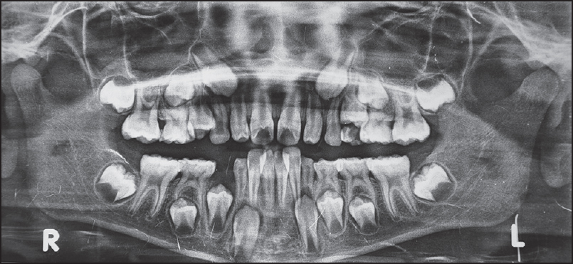 Figure 1: Pretreatment orthopantomogram showing full eruption of permanent lower first molars