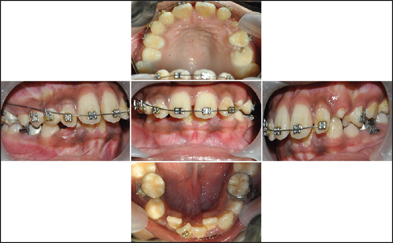 Figure 2: Intraoral photographs showing brackets on deciduous upper right canine and recently exfoliated deciduous upper left canine (which was with bracket according to patient history). Further note the presence
of molars bands on deciduous lower second molars on both sides
