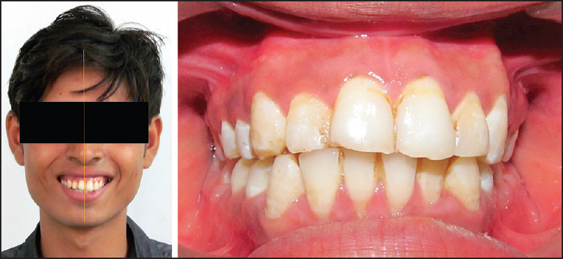 Figure 2: Evaluation of concordance of facial and dental midlines